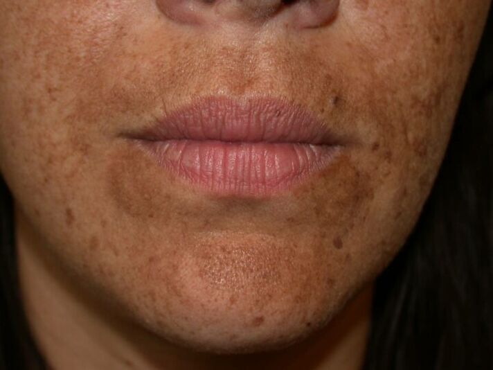 Macchie pigmentate sul viso sono un'indicazione per una procedura laser