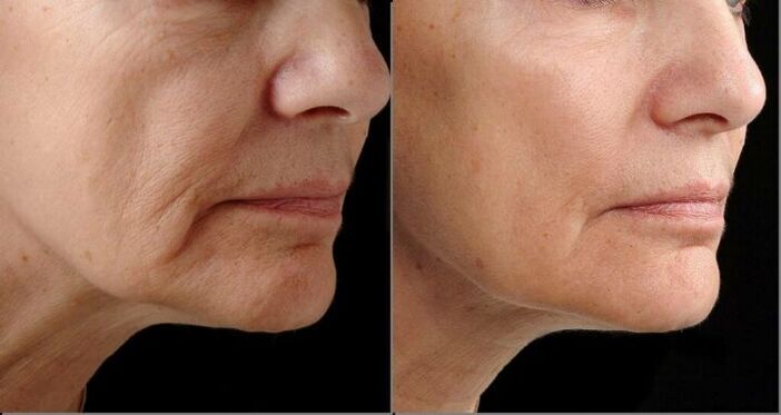 Pelle del viso prima e dopo la procedura di ringiovanimento laser
