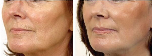 Prima e dopo il peeling laser