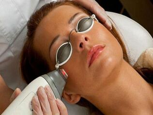 ringiovanimento facciale laser